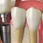 What Are The Risks Associated With Dental Implant Surgery?