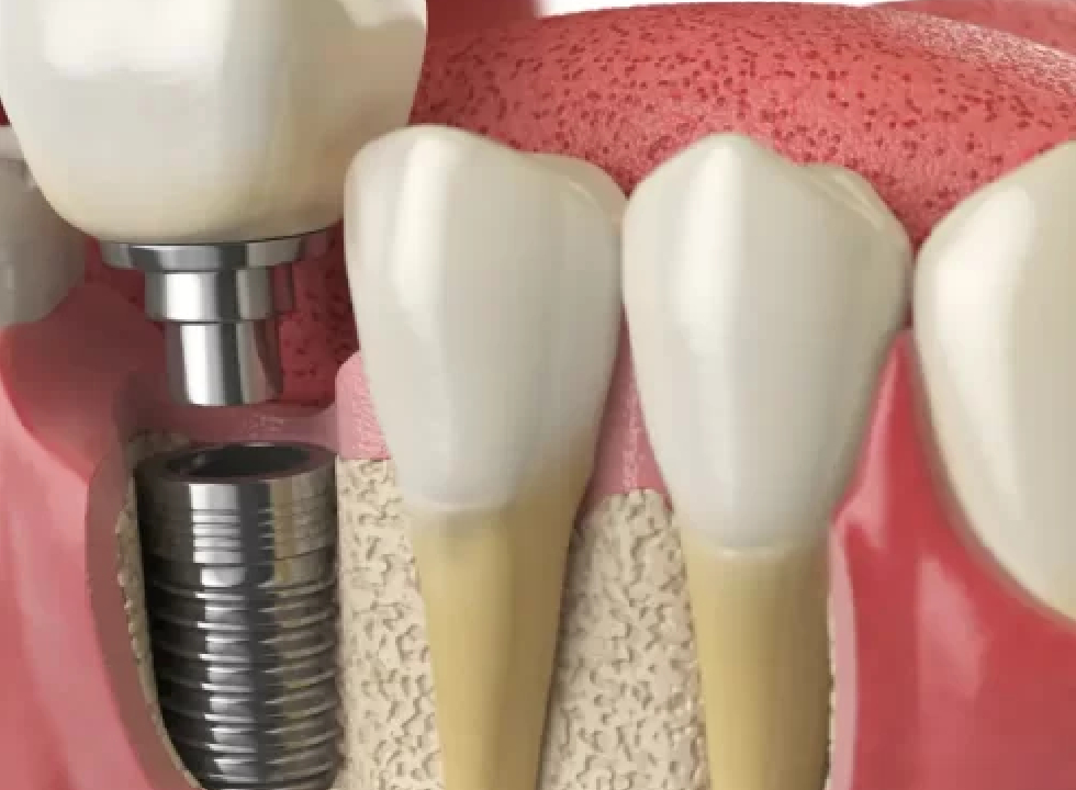 What Are The Risks Associated With Dental Implant Surgery?